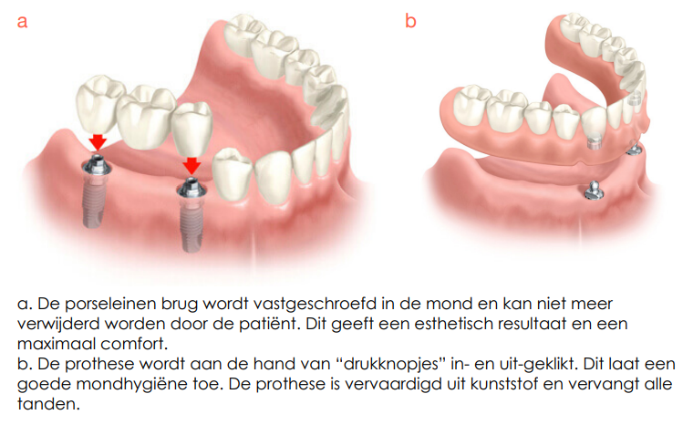 implantologie desteldent