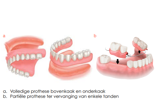 prothese desteldent