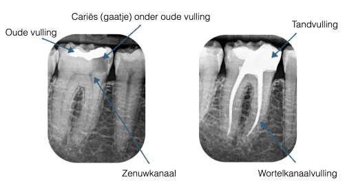 wortelkanaalbehandeling desteldent