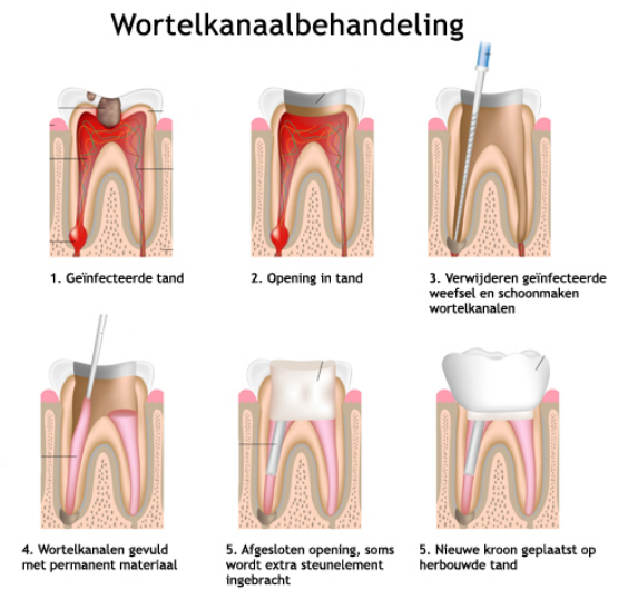 wortelkanaalbehandeling desteldent